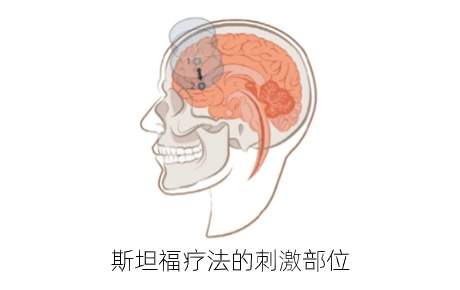 高質(zhì)量文獻(xiàn)：多療程斯坦福療法（SNT）對(duì)重度抑郁癥復(fù)發(fā)后療效驗(yàn)證