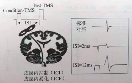 科普丨前途無量的TMS新模式——單拍成對(duì)脈沖刺激（pTMS）